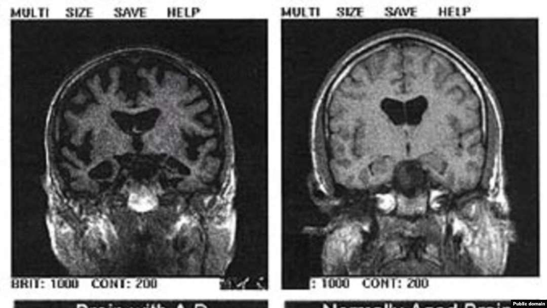 Komjuterizovana tomografija glave pokazuje razliku u nalazu kod pacijenta s Alzheimerovom bolesti i kod zdravog pojedinca, arhivska fotografija